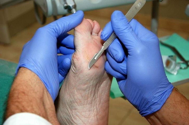 Castilla-La Mancha ofreció más de 9.000 tratamientos podológicos gratuitos a pacientes diabéticos
